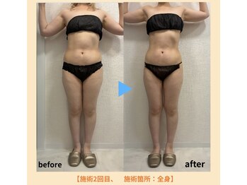 エラ(Ella)の写真/【本気の引き締め】全身を温め揉みほぐし、効果的に脂肪・セルライトを落とす最新痩身施術￥16500→￥10800