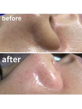 ココ(Coco)/毛穴洗浄・ソフトピーリング