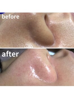 ココ(Coco)/毛穴洗浄・ソフトピーリング