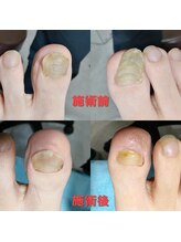 ドクターネイル爪革命 長野店/【肥厚・変形爪】ネイル/フット