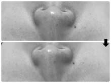 エフェクト 塚口店(effect)/Before After &nbsp;&nbsp;20代/1回目