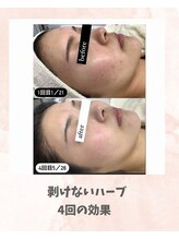 リンフェイス 浦安店(RINFACE)/ハーブピーリング×乳歯幹細胞