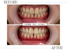 ホワイトニングサロンブライト 尼崎店(Whitening salon bright)/お試しのみでも効果あり！！