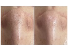 サロン マリー(SALON MARIE)/頑固な毛穴詰まり改善へ