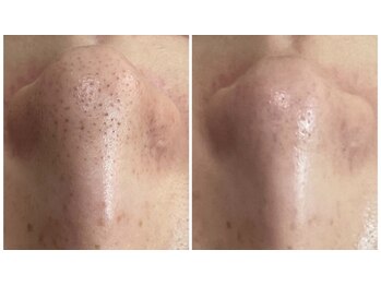 サロン マリー(SALON MARIE)/頑固な毛穴詰まり改善へ