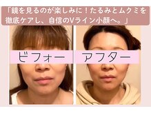 小顔・ほうれい線・歪み・顔長・目のたるみ・を叶える！