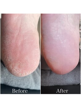 アモット(Amout)/足爪ケア＆足裏の角質ケア