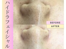 Cスキンケアクリニック 麻布店/毛穴洗浄ハイドラフェイシャル