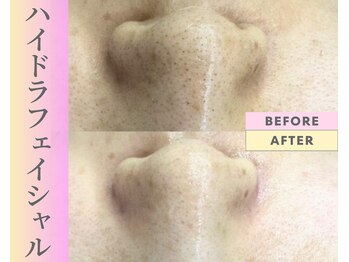 Cスキンケアクリニック 麻布店/毛穴洗浄ハイドラフェイシャル