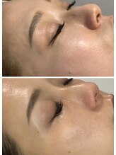 ラグ(LUXU)/肌育ピーリング