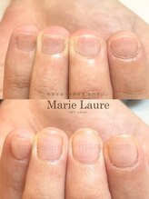 マリーロール 梅田店(Marie Laure)/深爪矯正/自爪育成/自爪風