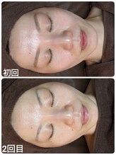 ウララ(ulala)/セラピール2回目