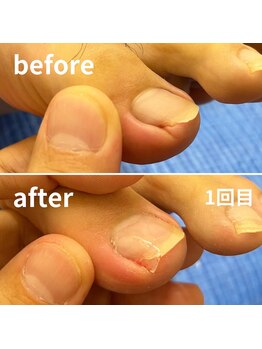 かがわ接骨院 高松伏石院/巻き爪でお悩みの方へ！