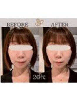 チョコバリ 錦糸町店(chocobari)/小顔×リフトアップ(美容鍼)20代