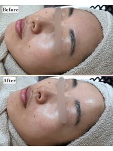 ソワナ(soina)/【神楽坂駅/フェイシャル/毛穴】