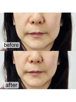 トゥインクル(Twinkle)/気になるほうれい線も…