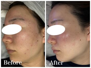 ノア 新宿(Noa)/ハーブピーリング＋マシン 6回