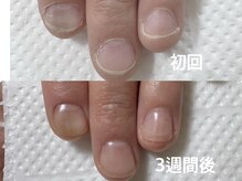 アメジスト(Amethyst)/【深爪矯正】初回～3週間後！