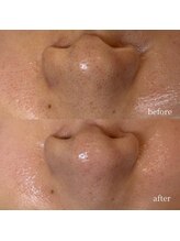 アーネスト 大阪心斎橋店(EARNEST)/泡＋水光 【 角栓・開き毛穴 】