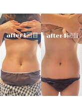 リリーボーテ 下北沢/インディバ施術（お腹）