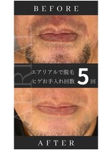 エアリアル 玉名店/5回でかなりの変化！ヒゲ脱毛