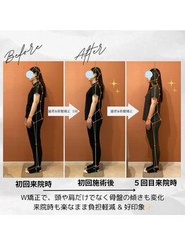 ラクリエ 姫路駅前院(La Creer)/姿勢ビフォーアフター/猫背/姿勢