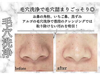 アルゴ 熊本八代店(ALGO)/ 大人気♪毛穴ごっそり大洗浄！