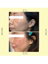 縁(エニシ)/エクソリフト