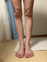 ヨサパーク カズリー(YOSA PARK kazury)/左が水素足湯30秒した足です！