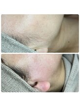 アーヒル(A”-HILU)/ワックス脱毛