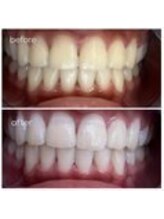 エクシアホワイトニング 津駅前店/お客様ビフォーアフター