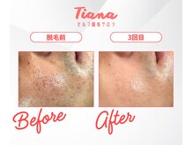 ティアナ 秋田大館店(Tiana)/顔脱毛　Before＆After