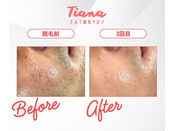 ティアナ 秋田大館店(Tiana)/顔脱毛　Before＆After