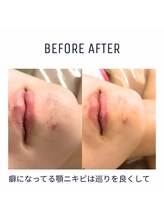 ルサンク(le cinq)/繰り返す顎ニキビ