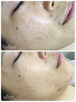 メイユール(MEILLEUR)/光フェイシャル