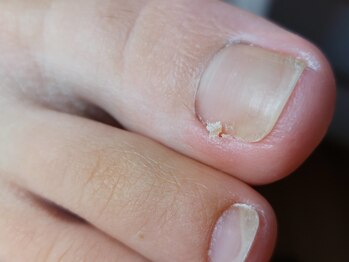 爪切り屋 足楽/１０代女性◆爪溝鶏眼