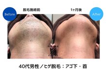 サロンアメリ イオンモール綾川店(Salon Ameri)/香川　脱毛　メンズ脱毛