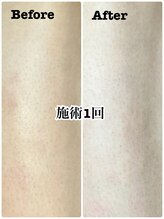 リノ(Lino)/男性☆膝下脱毛/1回施術後