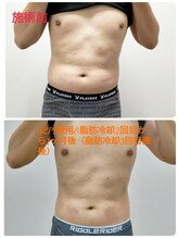 縁(en)/脂肪冷却２回