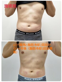 縁(en)/脂肪冷却２回