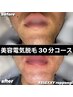 **First-Time Customers Only Electrolysis30Min¥10,000★Men and Women OK★