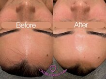 クレヴィア バイ サイバーエステ(CREBIA)/◎1回で圧倒的美白！