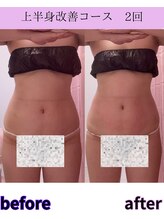 リラ(Lilas)/【痩身】たるみ上半身コース　