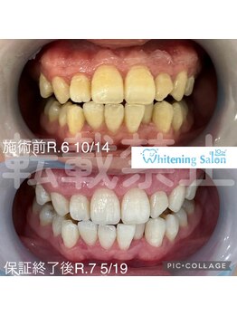 ホワイトニングサロン 名古屋 栄店/【ホワイトニング】