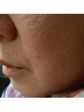 ハルリ(Haruri)/ハーバルピールでお肌剥離中。。