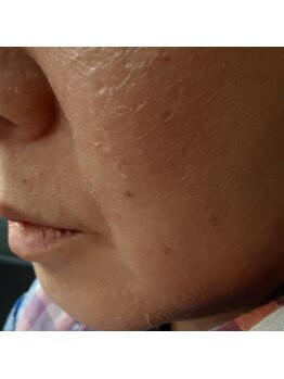 ハルリ(Haruri)/ハーバルピールでお肌剥離中。。