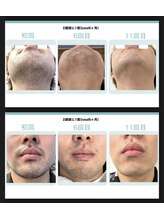 ペルレ(Perle)/ひげ　症例写真 3