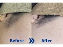 ストラッシュ 一宮店(STLASSH)/施術例：もみあげ