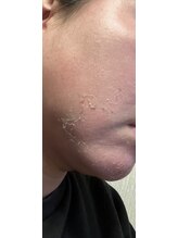 都/剥離してます