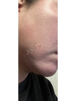 都/剥離してます